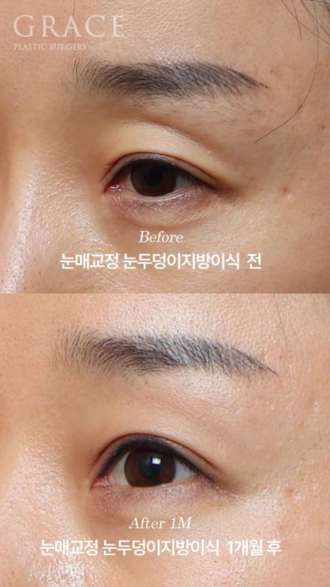 눈성형 부작용 후 재수술 안검하수 교정과 눈두덩이지방이식 1개월 경과 관련 이미지 3