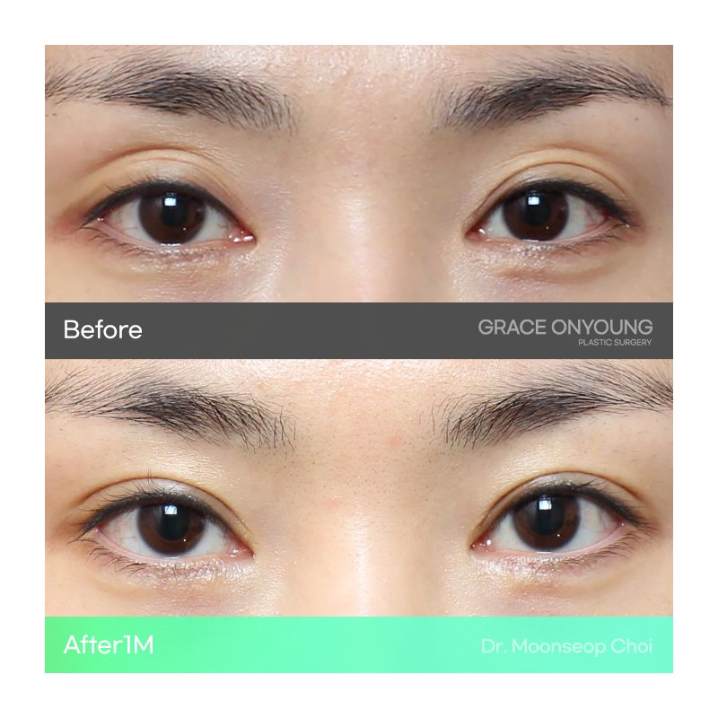 Shocked After Hearing That My Hollow Eyes and Sunken Eye Holes Were Severe? Upper Eyelid Fat Grafting image 5
