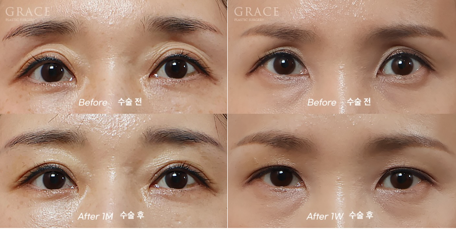 Why Do Hollow Eyelids Occur, and How Can They Be Naturally Improved? (Research Notes from a Doctor Performing Eyelid Fat Grafting) image 9