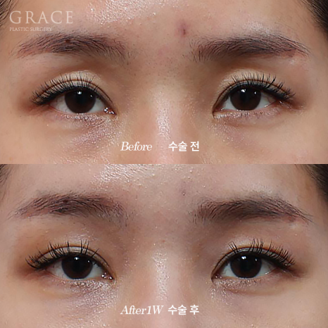 Complications from Sunken Eyelid Fat Grafting? The Injection Location Determines the Result image 1