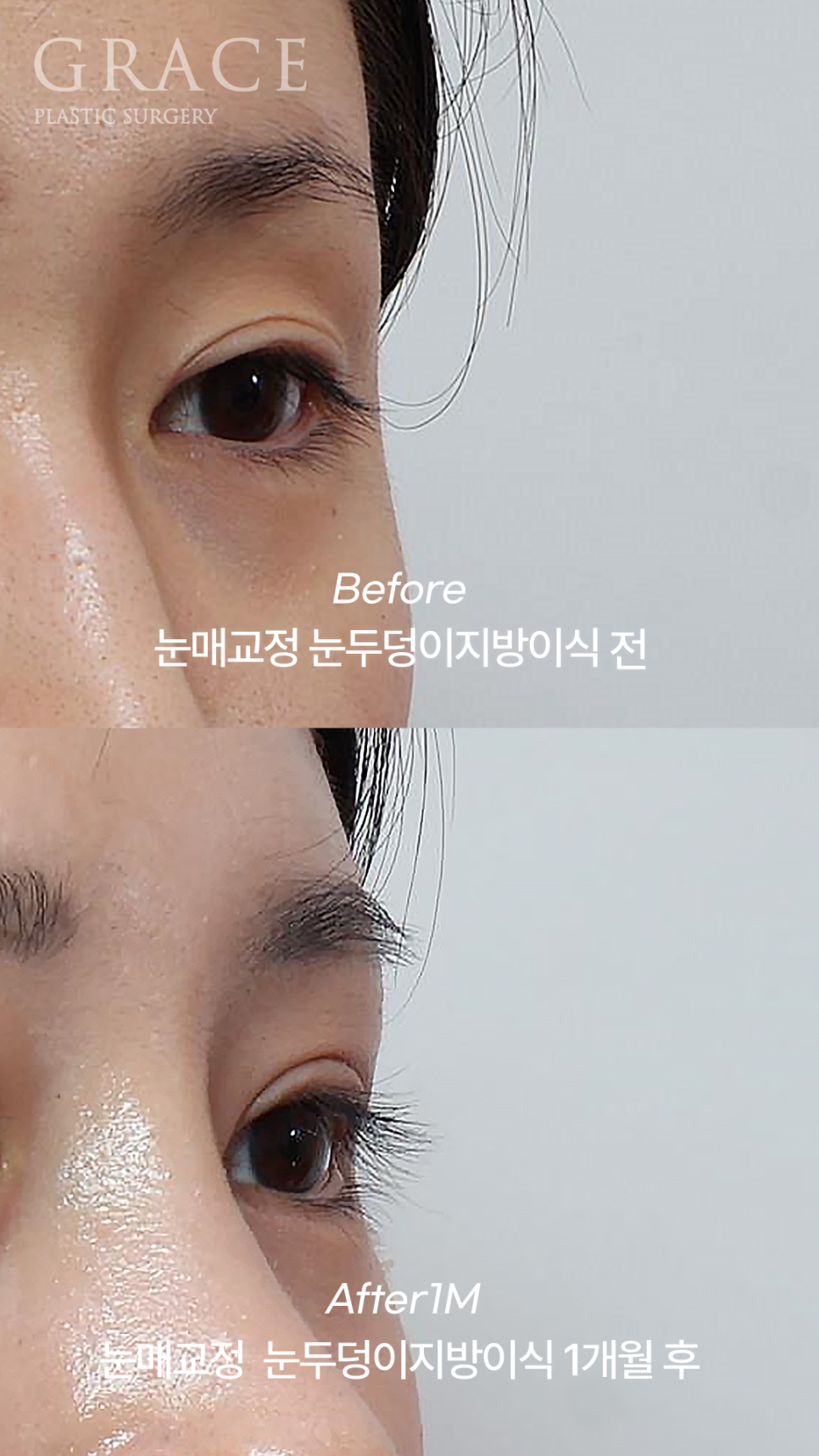 20대 후반 절개눈매교정+눈꺼풀지방이식 관련 이미지 6