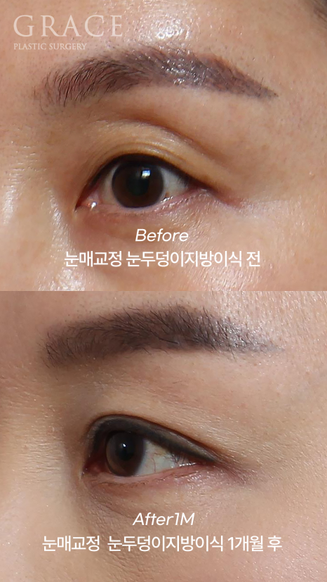 눈두덩이 지방이식 비절개 눈매교정 반드시 필요할까? (초이칼럼) 관련 이미지 5