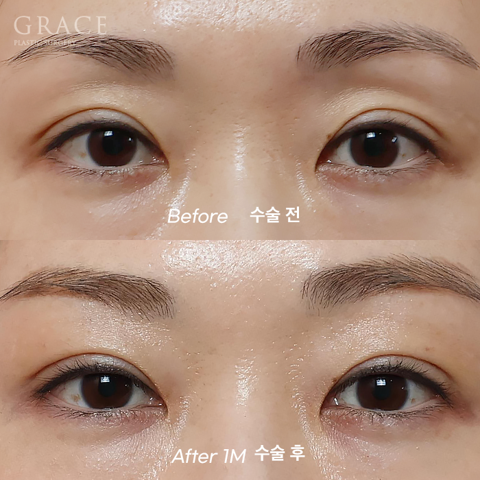 How Long Does Upper Eyelid Fat Grafting Last? The Facts About Maintenance Period image 1
