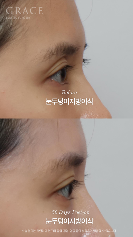 가을 되니 유독 퀭해 보이는 눈가 걱정? 눈두덩이 지방이식 56일차 관련 이미지 8
