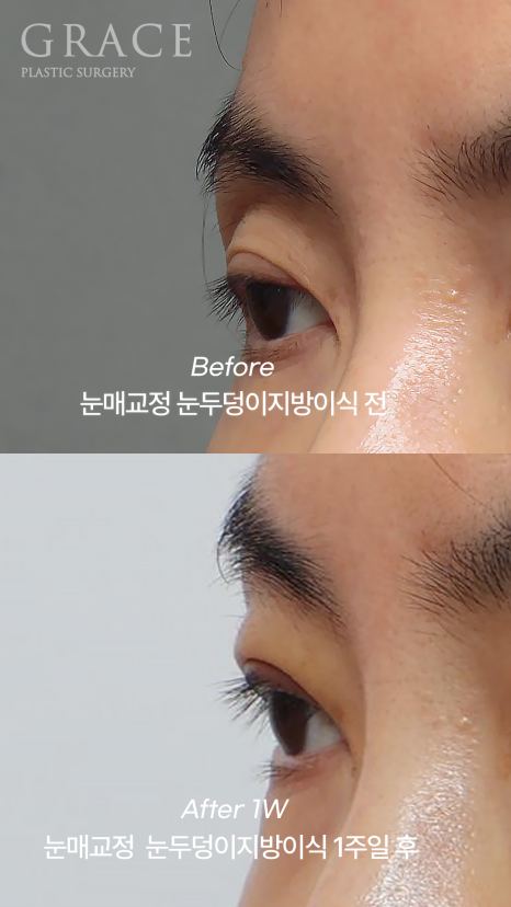 눈꺼풀 지방이식+눈매교정  40대 (눈 감았을 때 눈두덩이 흉터&middot;부작용 체크) 관련 이미지 3
