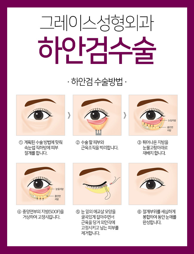 하안검수술후기로 부모님의 젊음을 찾아드리자! 관련 이미지 4