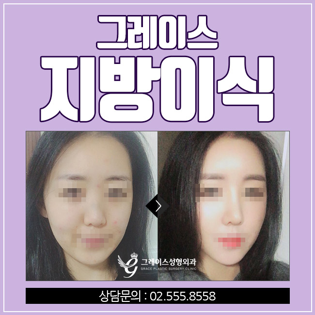 꽉 찬 생기를 채워주는 그레이스성형외과 지방이식 관련 이미지 5