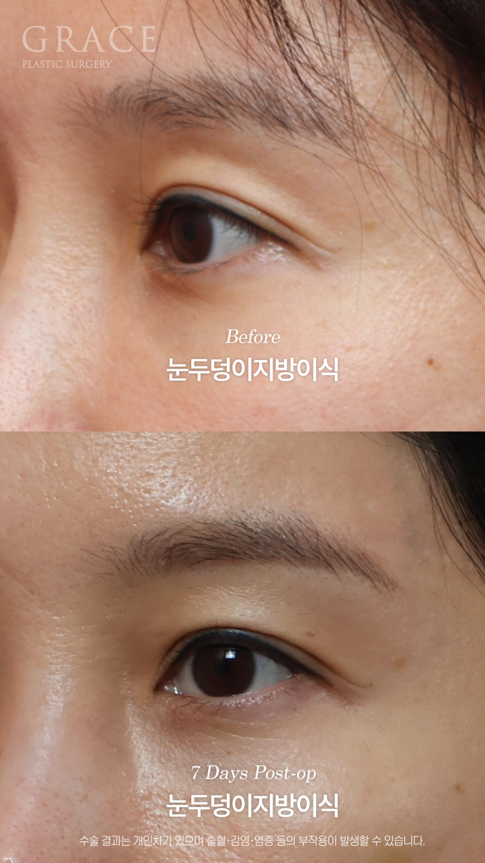 눈두덩이지방이식 하고 일주일 출근 가능한 정도일까? 관련 이미지 6