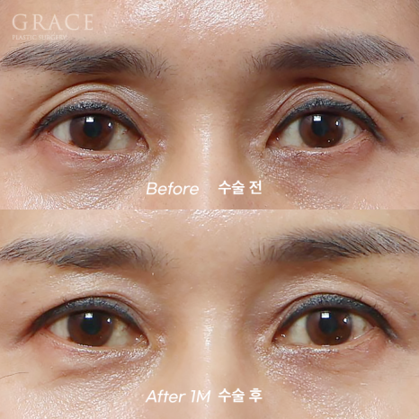 Upper Eyelid Fat Grafting Cost · Swelling, Reviews & Side Effects image 9