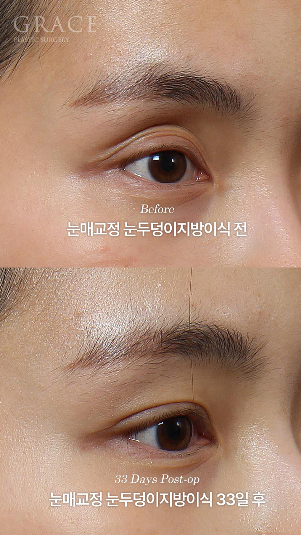 눈매교정 망하고 눈재수술 &middot; 눈두덩이 안와지방이식 관련 이미지 3