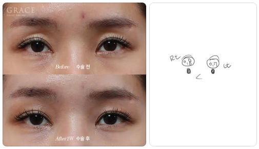 Complications from Sunken Eyelid Fat Grafting? The Injection Location Determines the Result image 3