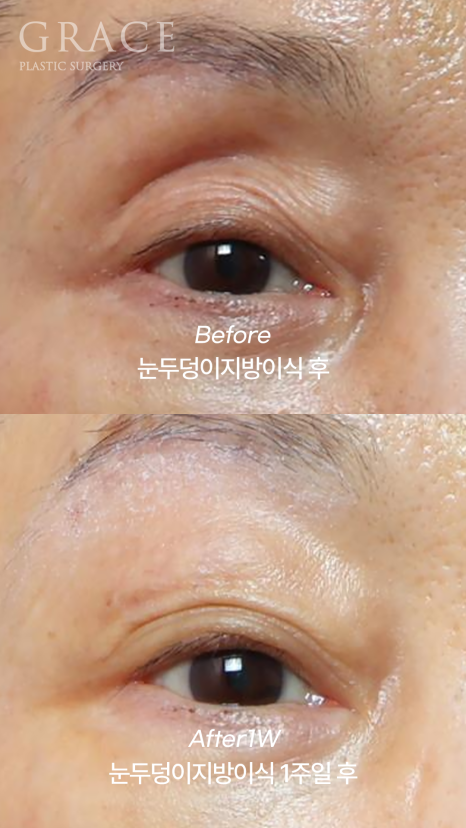 Upper Eye Hollowing and Sunken Brow Bone: Before and After 1 Week of Fat Grafting for a Patient in Her Mid-70s image 2