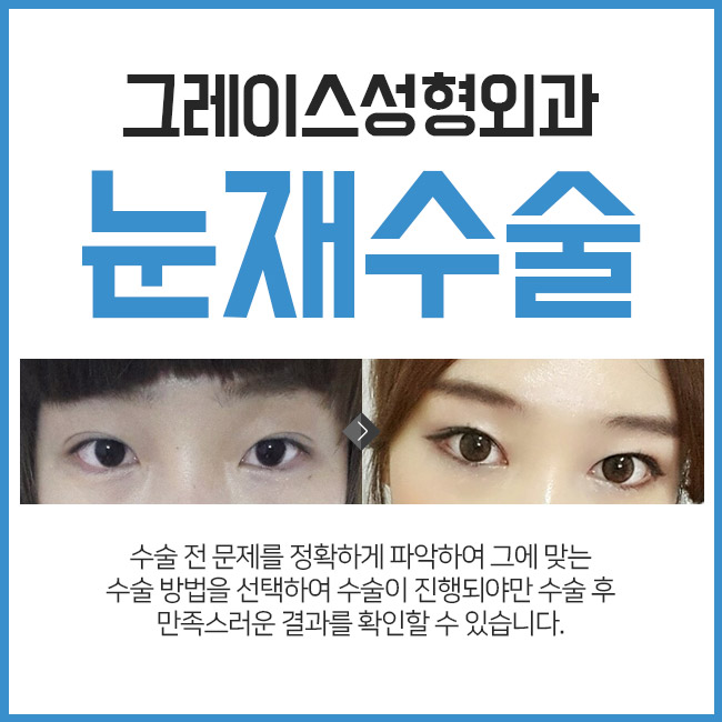 쌍수재수술후기 이곳이 정답인 이유 관련 이미지 3