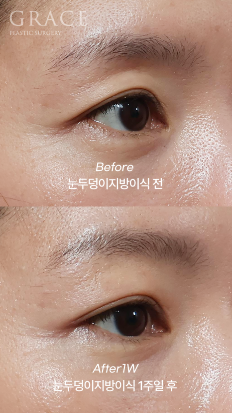 눈위꺼짐 눈두덩이 지방이식으로 자연스럽게 개선하기 관련 이미지 3