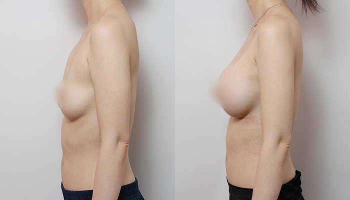 Sagging Breasts and Nipples After Motiva 355cc! image 3