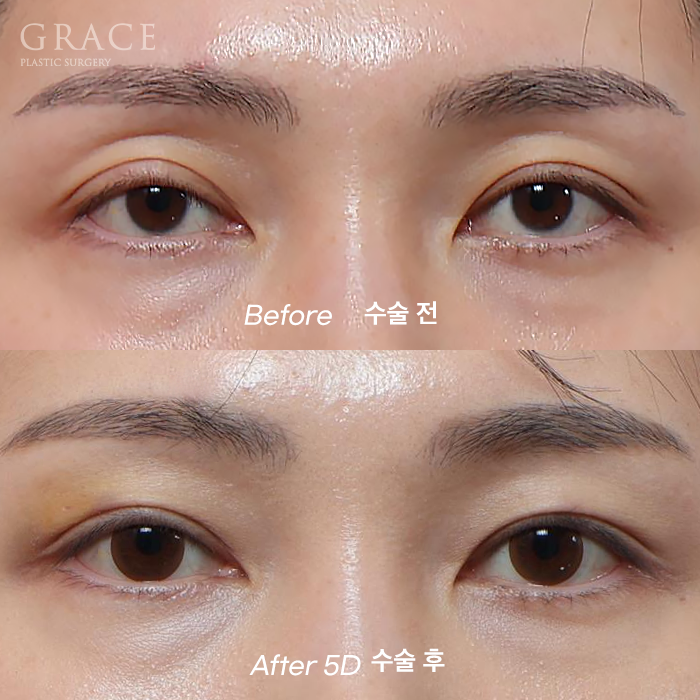 Eyelid Fat Grafting Bruising and Swelling Side Effects (Natural Eyelid Line After 5 Days) image 1