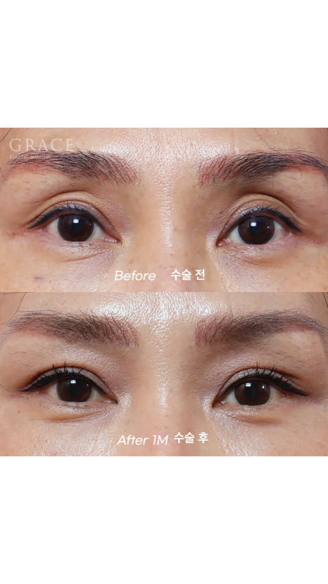 Uneven When You Close Your Eyes? Before-and-After of Eyelid Fat Grafting That Took Well Without Swelling (Compared with Filler) image 1