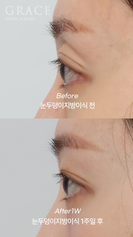 눈꺼풀 지방이식 잘하는 병원 그레이스성형외과 관련 이미지 7