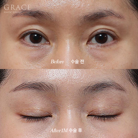 Why Choose Upper Eyelid Fat Grafting Instead of Eye-Hollow Filler? image 4