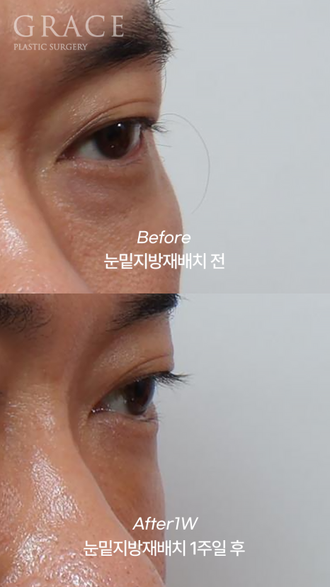 눈두덩이 지방이식 vs 눈밑지방재배치 (40대 중반 남자자&middot;비용&middot;붓기) 관련 이미지 3