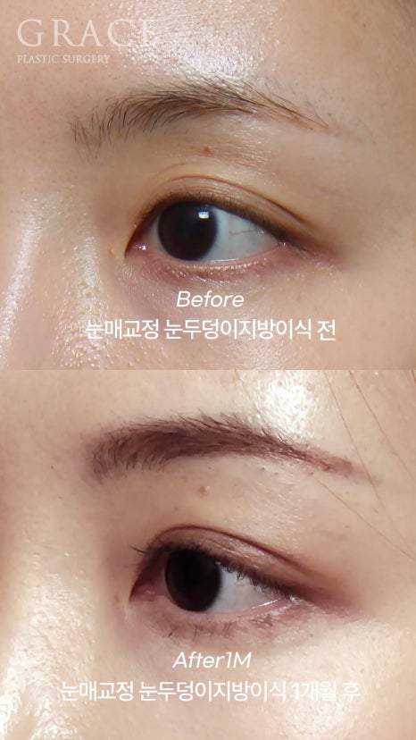 Eyebrow Hollow Fat Grafting Before and After Comparison – Gently Filling Sunken Eyes image 23