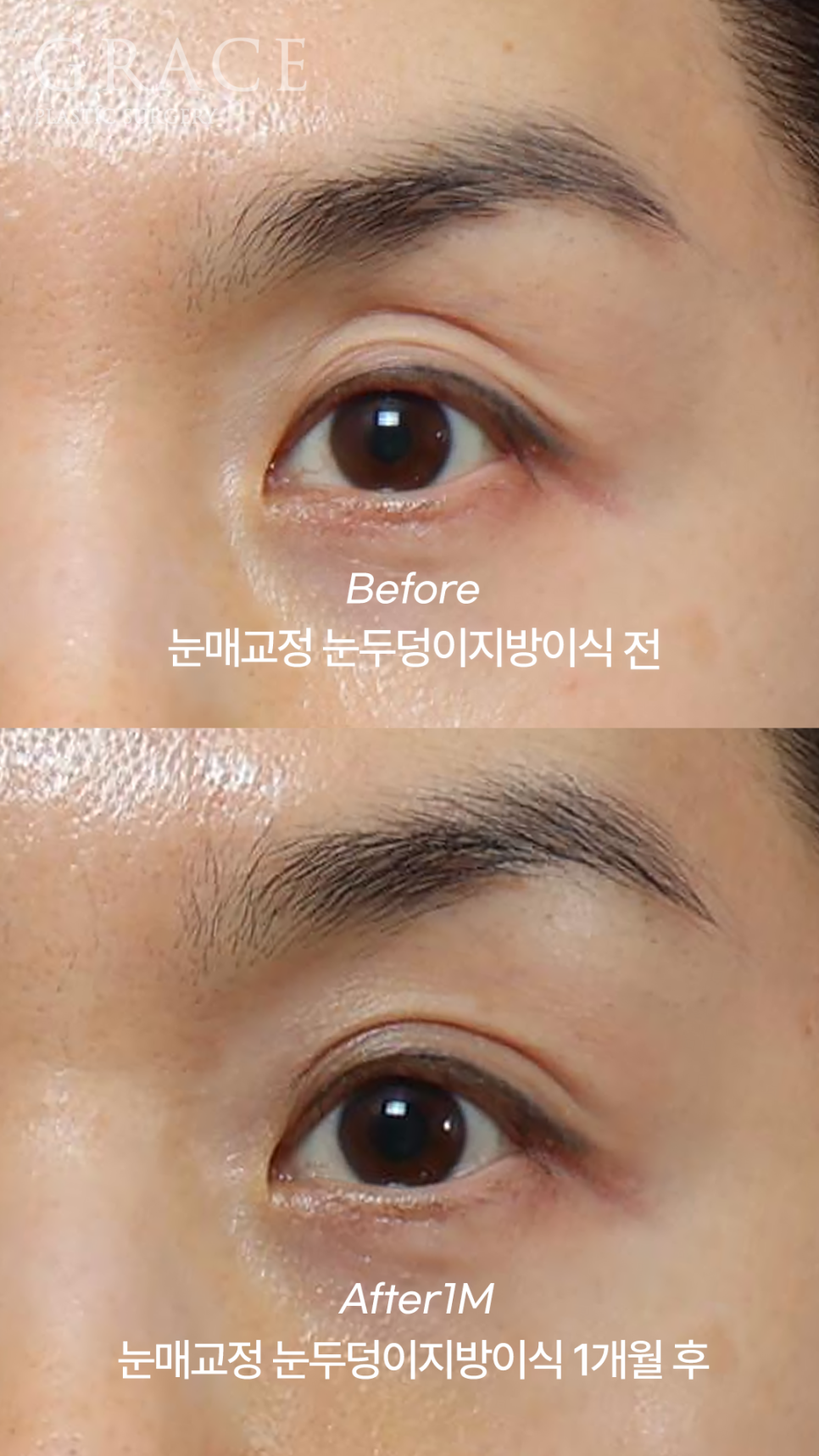 Sunken Upper Eyelids: Fillers or Fat Grafting? image 2