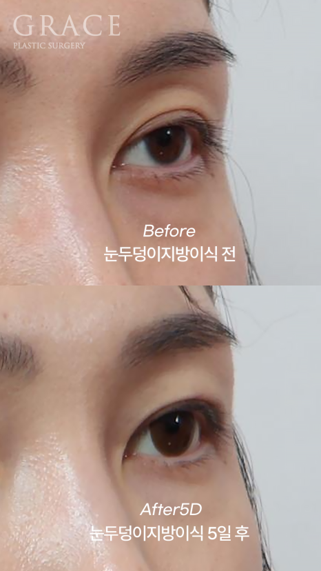 Eyelid Fat Grafting Bruising and Swelling Side Effects (Natural Eyelid Line After 5 Days) image 6