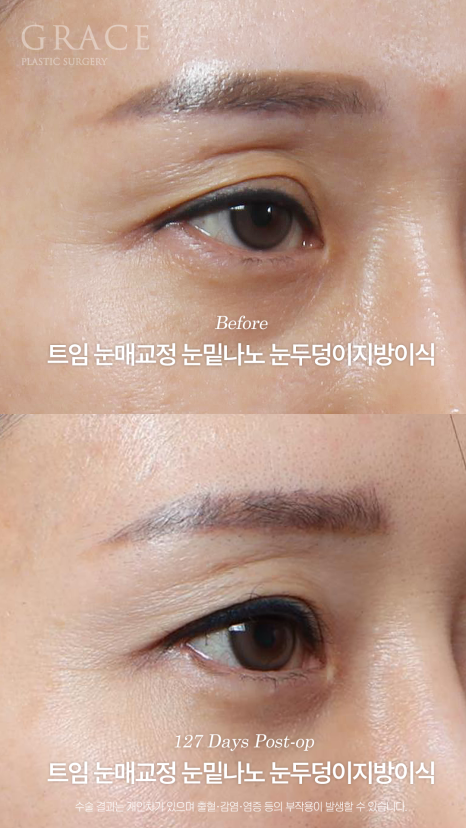 20년 전 쌍꺼풀 수술 겹쌍꺼풀에 눈두덩이 꺼짐까지? 아이홀 지방이식 재수 관련 이미지 6