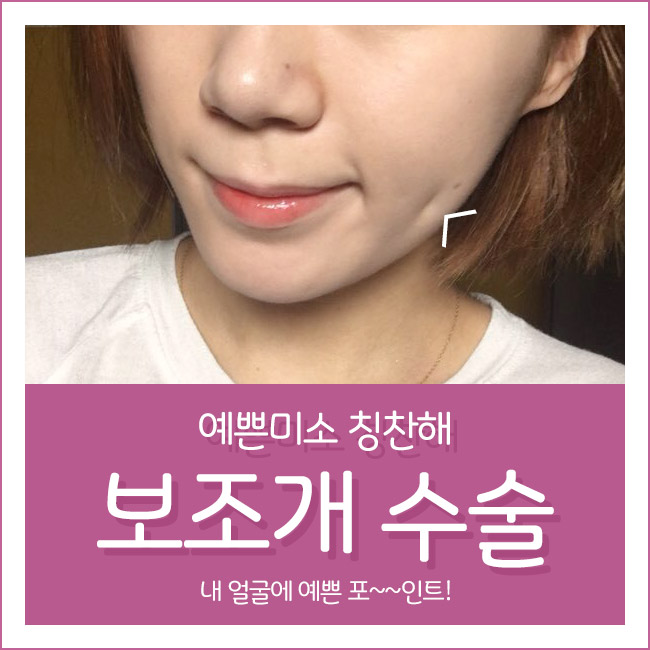 그레이스성형외과에서 보조개수술가격 알아보자! 관련 이미지 1