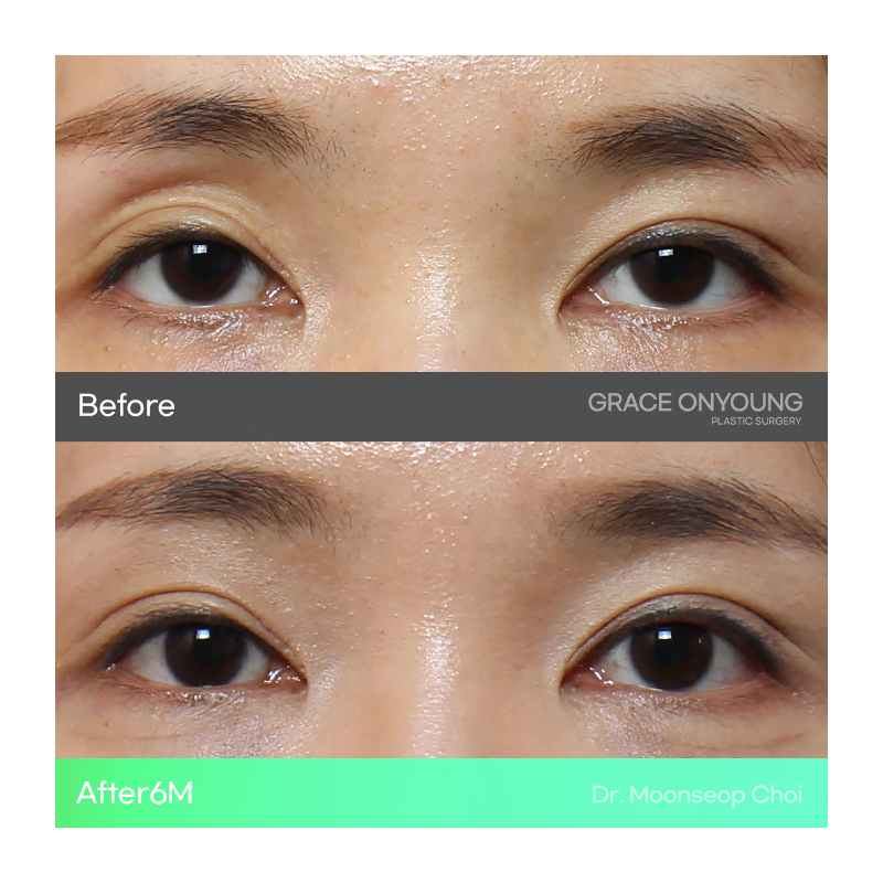 Shocked After Hearing That My Hollow Eyes and Sunken Eye Holes Were Severe? Upper Eyelid Fat Grafting image 9