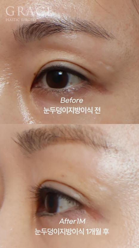 How Long Does Upper Eyelid Fat Grafting Last? The Facts About Maintenance Period image 4