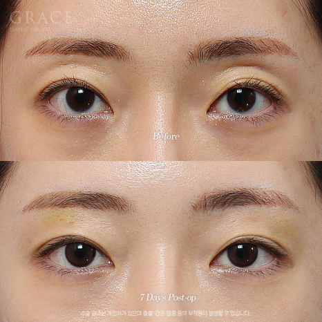 눈두덩이 지방이식이 필요한 경우 진료실에서는 무엇을 볼까요? 관련 이미지 1