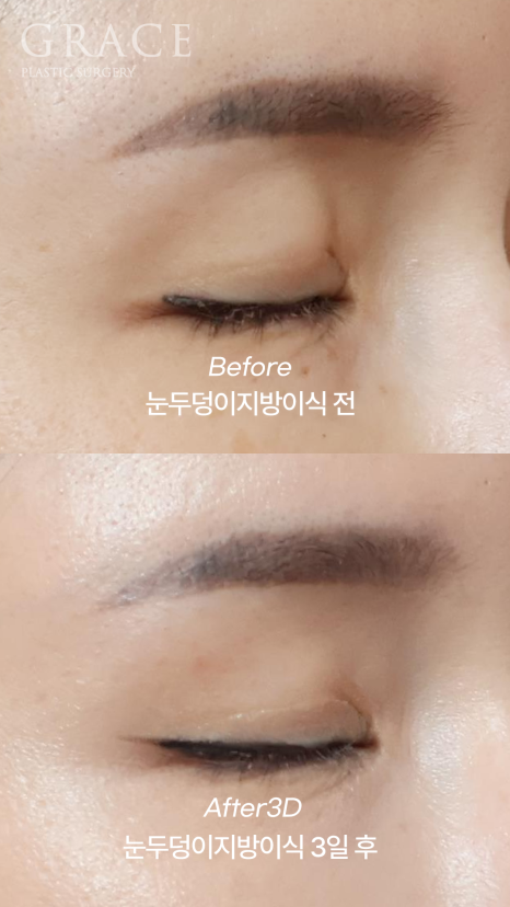 눈두덩이 지방이식 다운타임? 3일 후 흉터&middot;멍&middot;붓기 보여드립니다. 관련 이미지 5