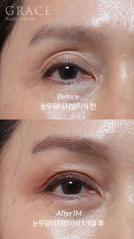눈두덩이 지방이식 걱정만 덜기 관련 이미지 1