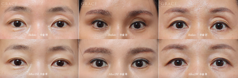 Why Eyelid Hollow Fat Grafting Fails If You Don’t Know This image 3