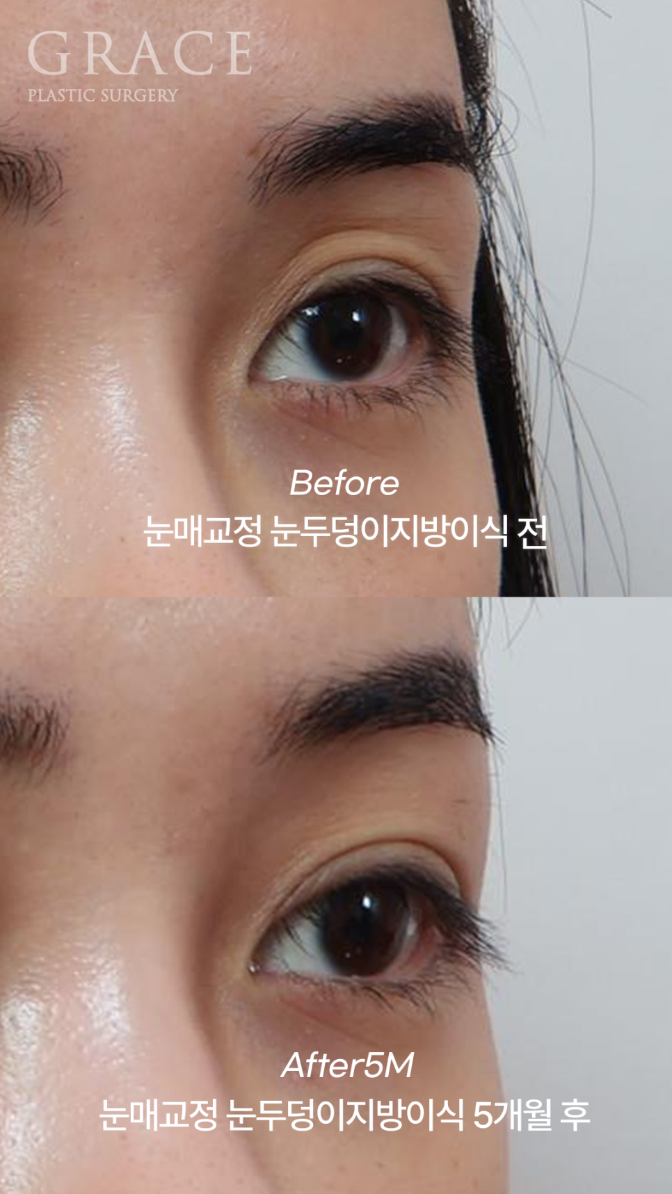 Introduction to a Case of Upper Eyelid Fat Grafting After Correction of Uneven Eyes image 6