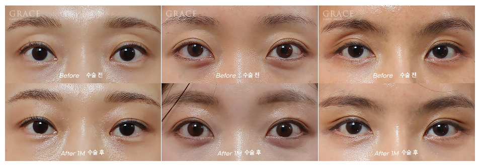 Why Eyelid Hollow Fat Grafting and Orbital Fat Injection Are Important: From Duration of Results to How to Prevent Bumpy Side Effects image 4