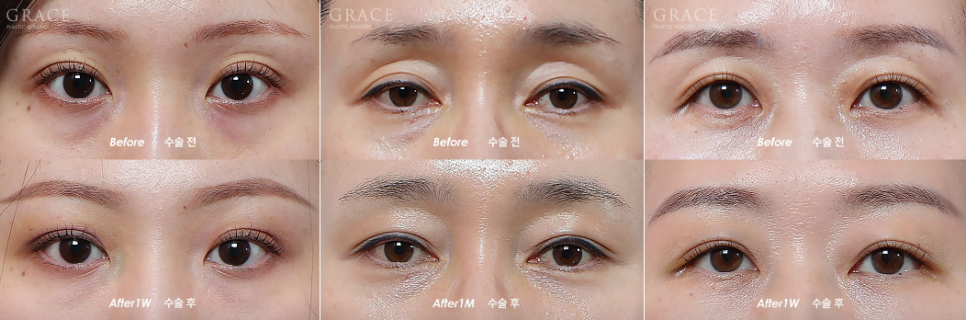 Why Eyelid Hollow Fat Grafting Fails If You Don’t Know This image 5