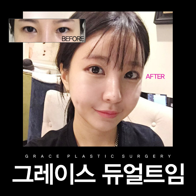 듀얼트임으로 선하고 예쁜눈매를 원한다면? 그레이스성형외과로 가즈아!! 관련 이미지 1