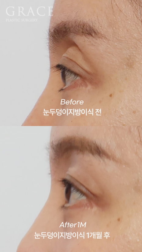 눈꺼풀 지방이식 보법이 다른 최문섭 원장님 실력 관련 이미지 9