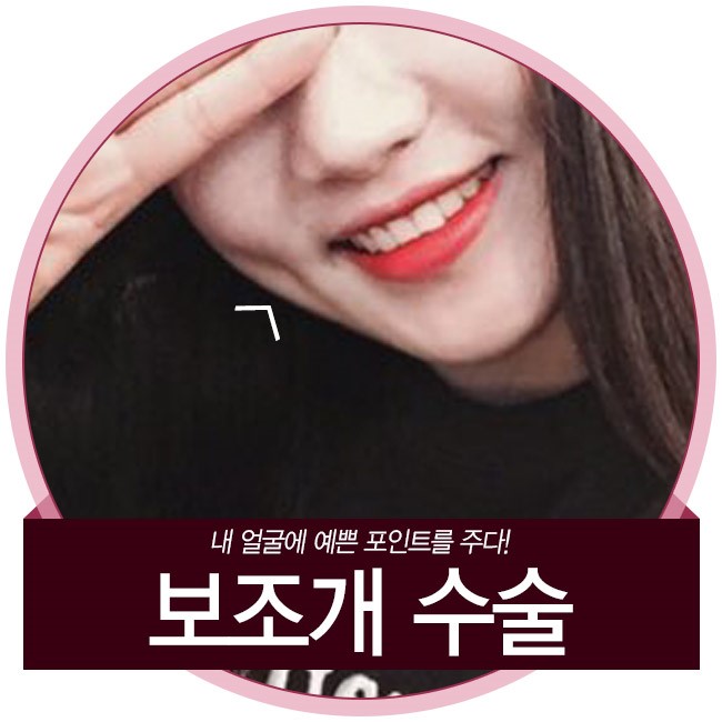 예쁜 미소 칭찬해, 그레이스성형외과 보조개 수술 관련 이미지 1