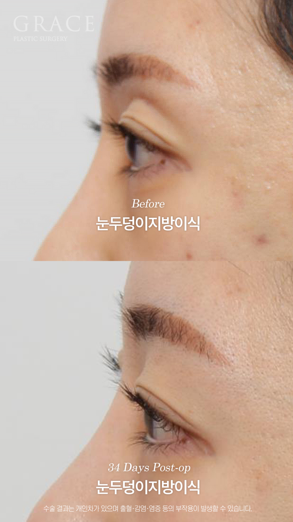 눈두덩이 지방이식이 필요한 경우 진료실에서는 무엇을 볼까요? 관련 이미지 8