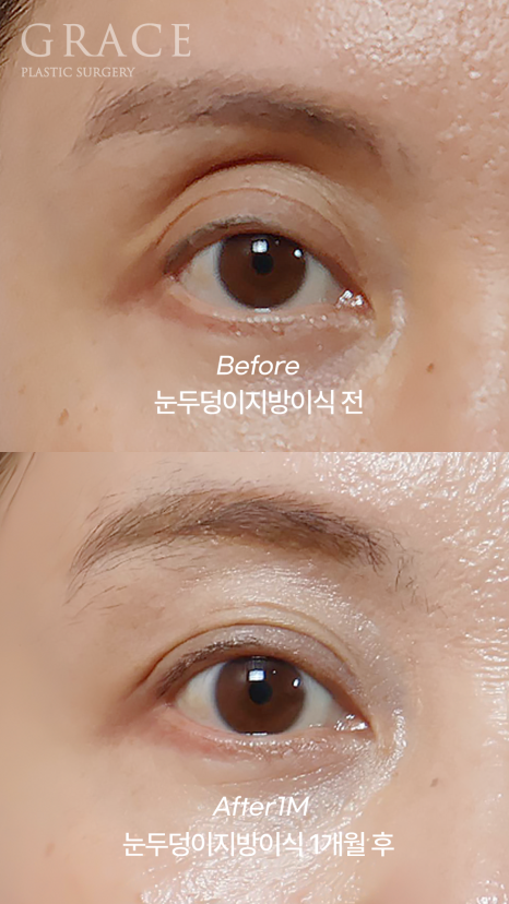 눈꺼풀 지방이식 보법이 다른 최문섭 원장님 실력 관련 이미지 1