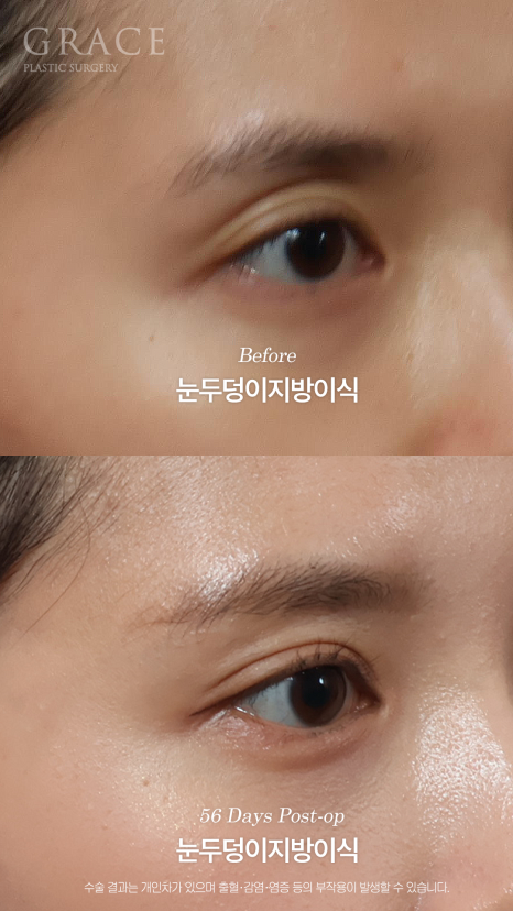 가을 되니 유독 퀭해 보이는 눈가 걱정? 눈두덩이 지방이식 56일차 관련 이미지 7
