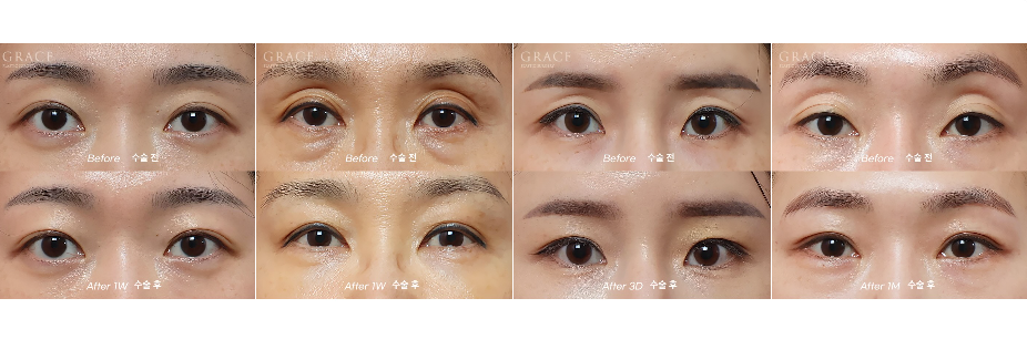 No to Frozen Fat That’s Completely Frozen! Eyelid Fat Grafting with Only Fresh Autologous Fat image 9