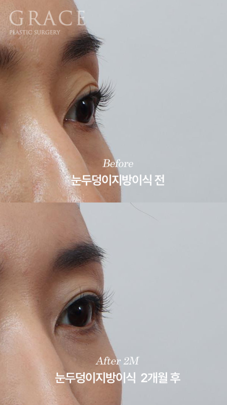 Is a Second Eyelid Fat Grafting Necessary? Are Frozen Fat Grafts a Side Effect? image 3