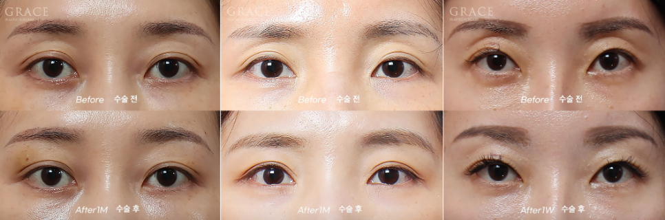 Before and After Eyelid Fat Grafting for Sunken Eye Hollows | Grace Plastic Surgery image 2
