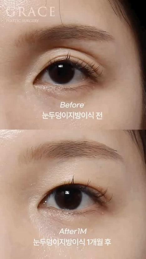 Eyebrow Hollow Fat Grafting Before and After Comparison – Gently Filling Sunken Eyes image 15