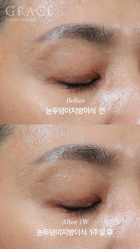 눈두덩이 부위에 절개해서 지방을 넣는다? 그레이스성형외과 아이홀 지방이식 방식에 대한 오해 관련 이미지 4