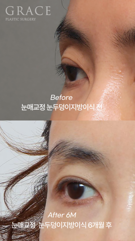눈꺼풀 지방이식+눈매교정  40대 (눈 감았을 때 눈두덩이 흉터&middot;부작용 체크) 관련 이미지 4